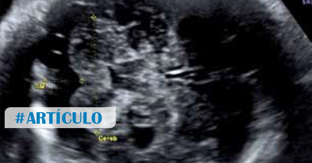 Diagnóstico Prenatal de agenesia del cuerpo calloso mediante Neurosonografía Volumétrica-3D